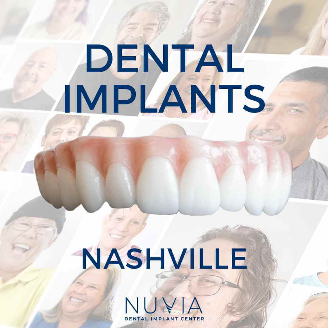 Graphic with dental implant prosthetic in Dallas