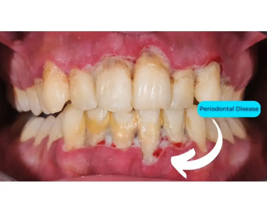 The Ultimate Guide to Full Mouth Dental Implants