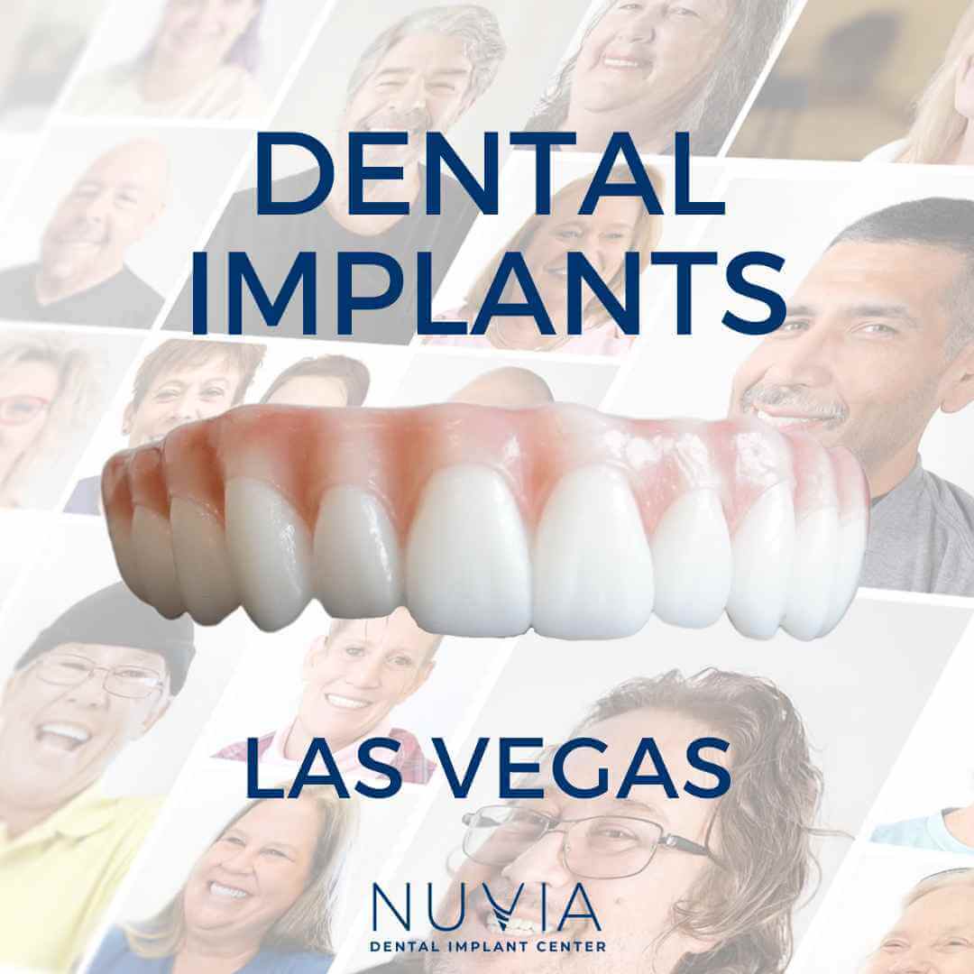 Graphic with dental implant prosthetic in Dallas