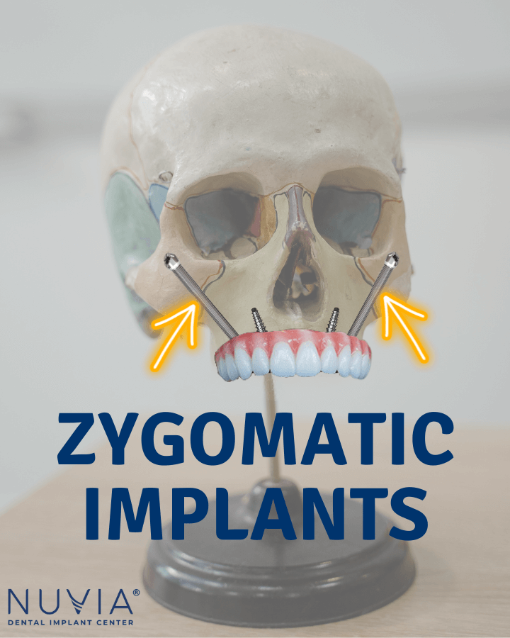 A skull model showing where zygomatic and traditional implants go in the upper jaw.