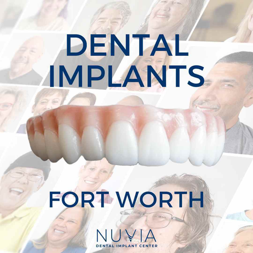 Graphic with dental implant prosthetic in Dallas