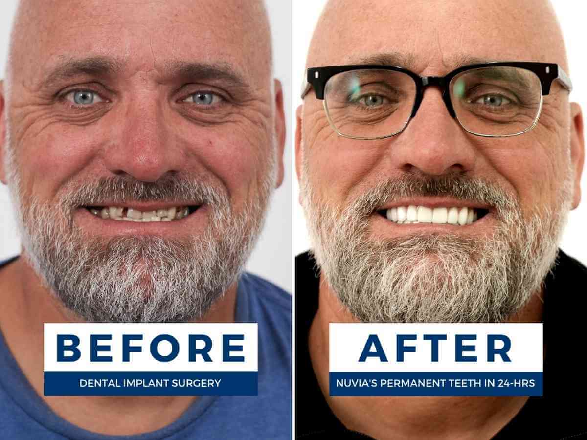 Before and after pictures of a man who just received dental implants'