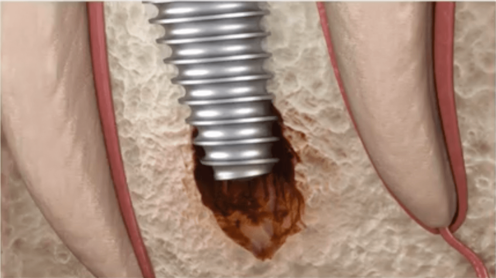 Graphic of a failed dental implant