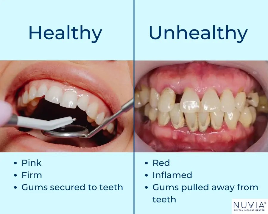 A set of healthy teeth next of unhealthy teeth