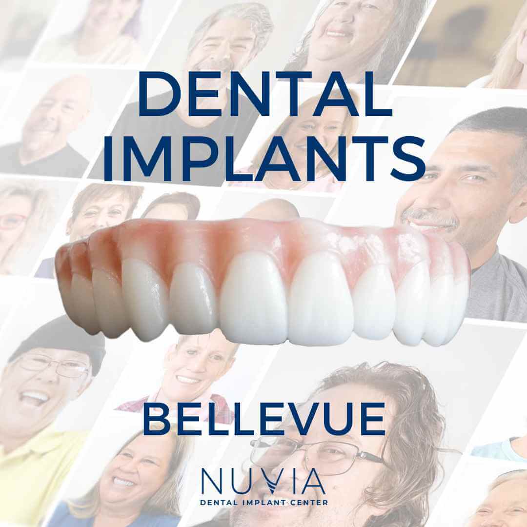 Graphic with dental implant prosthetic in Dallas