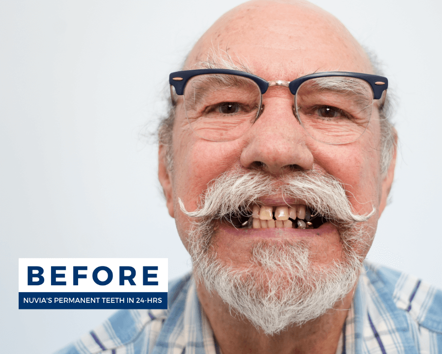Smiling patient before getting permanent dental implants