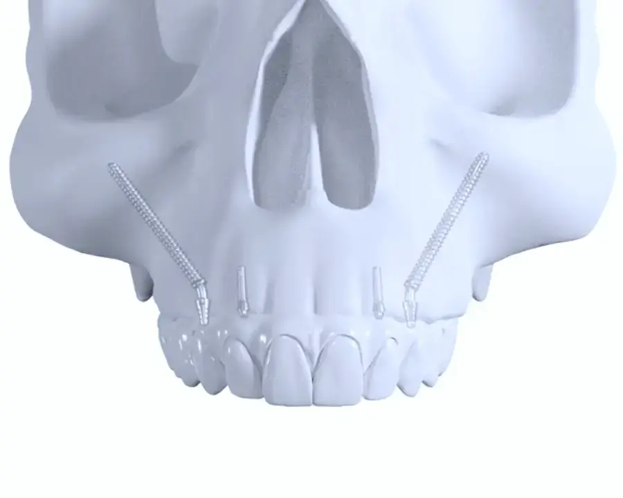 Illustration of Zygomatic Dental Implant Placement for an All on 4 prosthetic