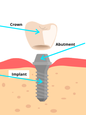 What is a dental implant? Crown, Abutment, and Implant.