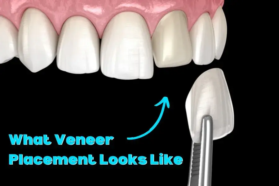 What Veneer Placement Looks Like
