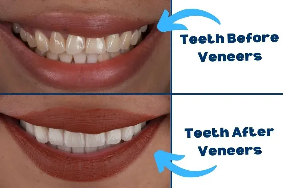 Veneers are used to fix slightly damaged teeth