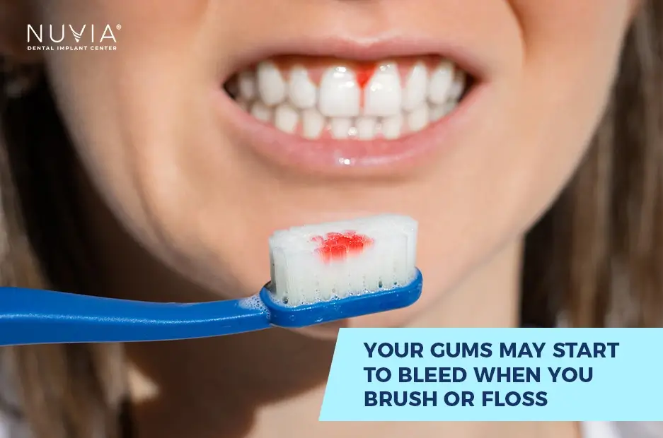 Signs of poor gum health