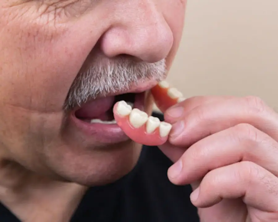 Partial Dentures Removed