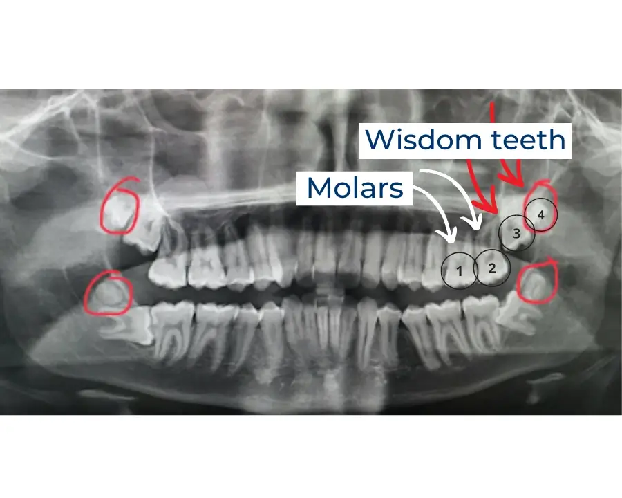 Scan of adams teeth pointing out wisdom teeth and molars