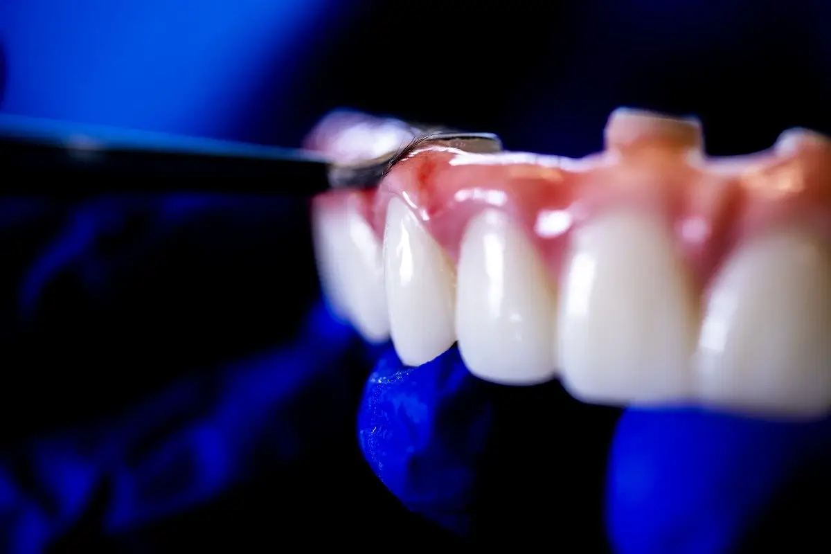 Close up of Prosthetic Teeth that fits on Dental Implants