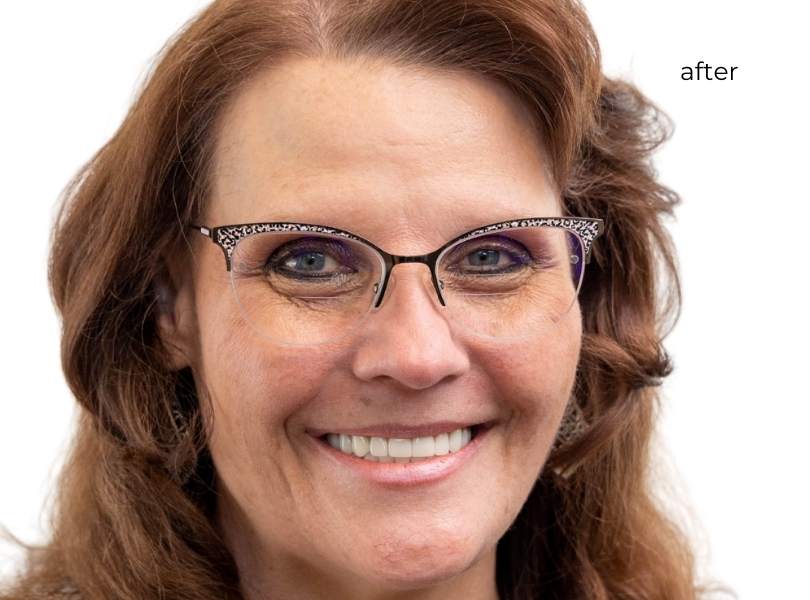 woman after getting dental implants