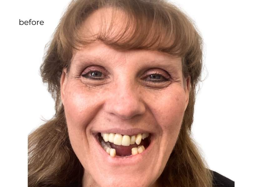 woman before getting dental implants