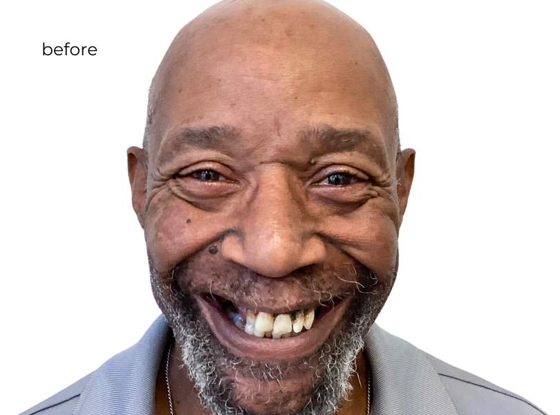 woman smiling before getting dental implants