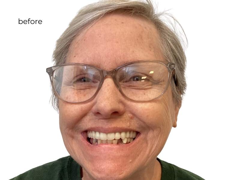 Man smiling before getting dental implants