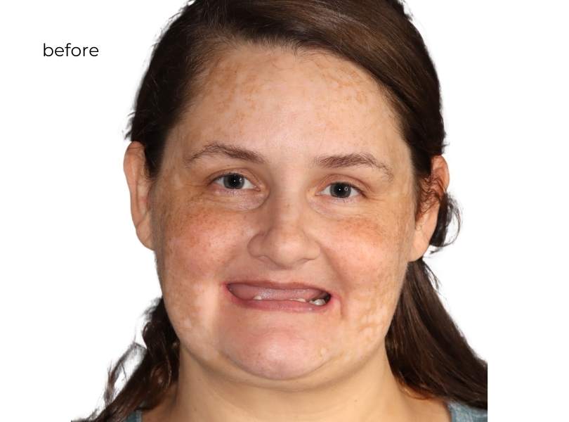 Man smiling before dental implants