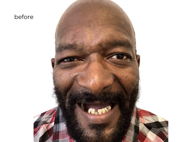 woman smiling before dental implants