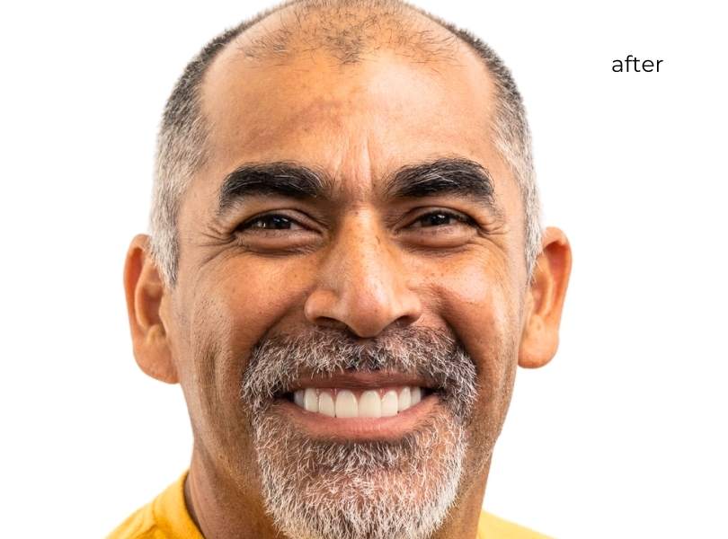Man smiling after getting dental implants