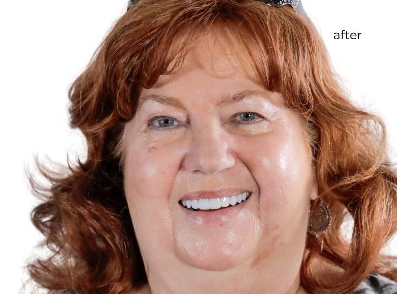 woman after getting dental implants