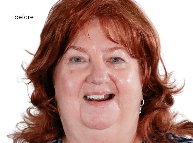 woman before getting dental implants