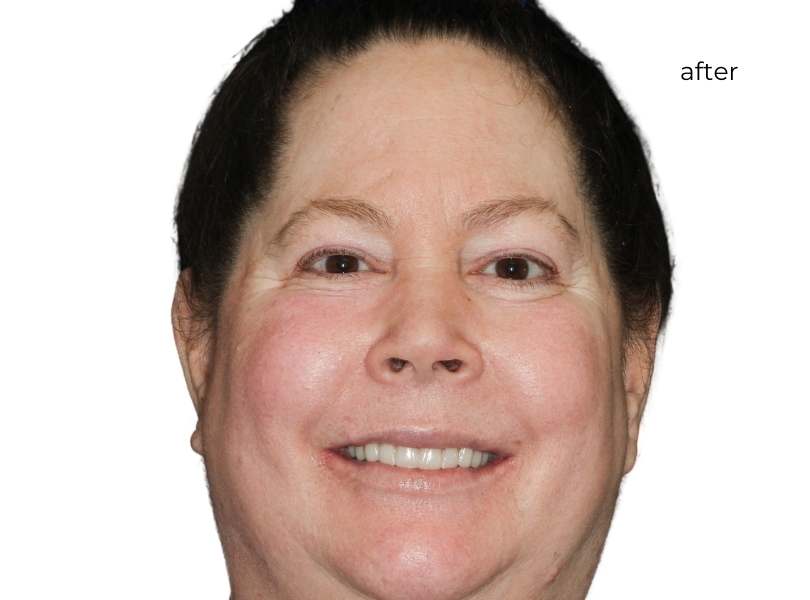 Woman smiling after getting dental implants