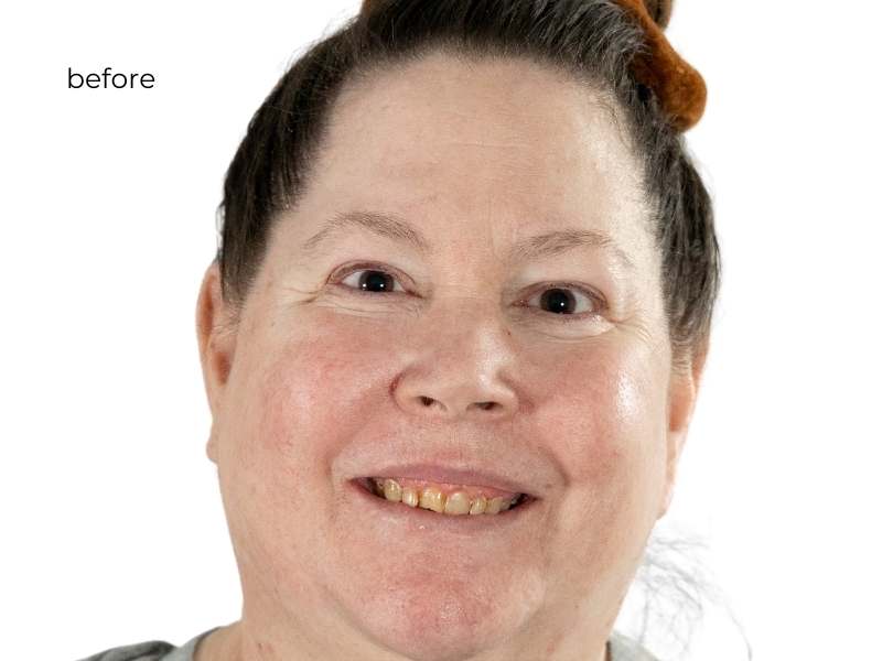 woman smiling before getting dental implants