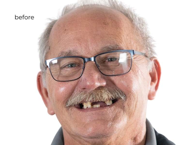 Man smiling before getting dental implants