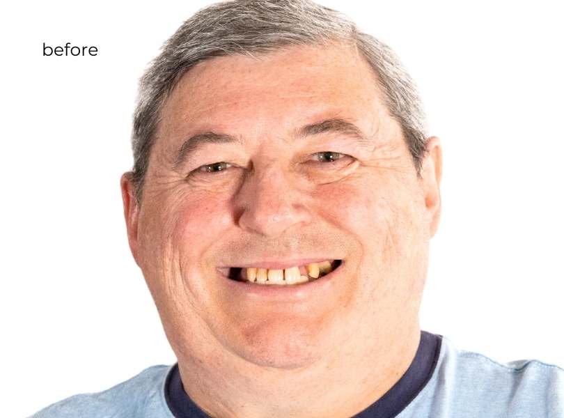 Man smiling before dental implants