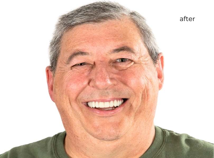 man smiling after getting dental implants