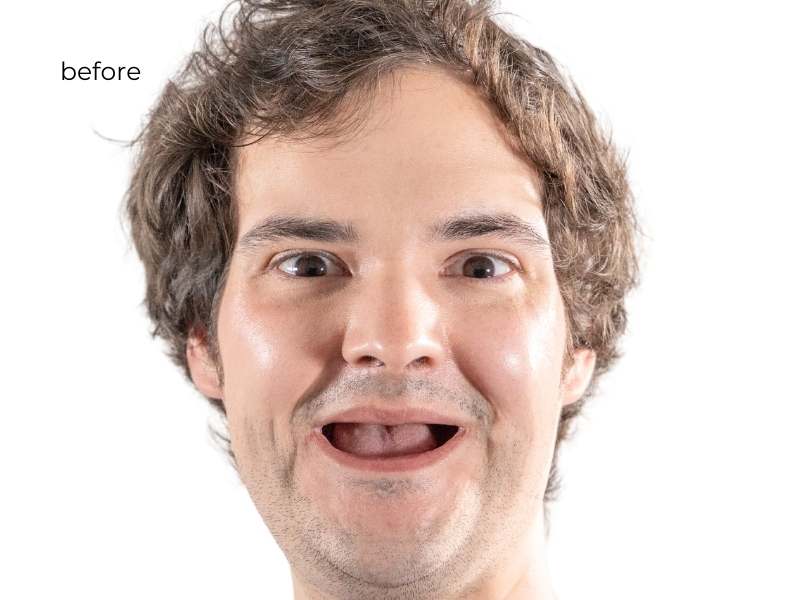 woman smiling before dental implants