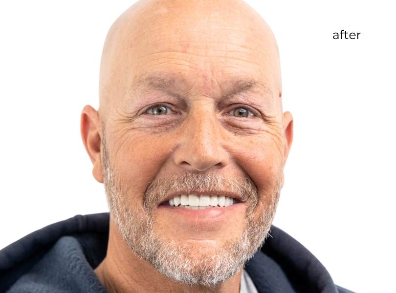 Man smiling after getting dental implants