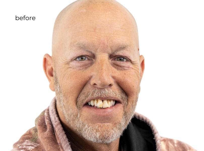Man smiling before getting dental implants