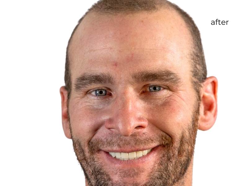 man smiling after getting dental implants