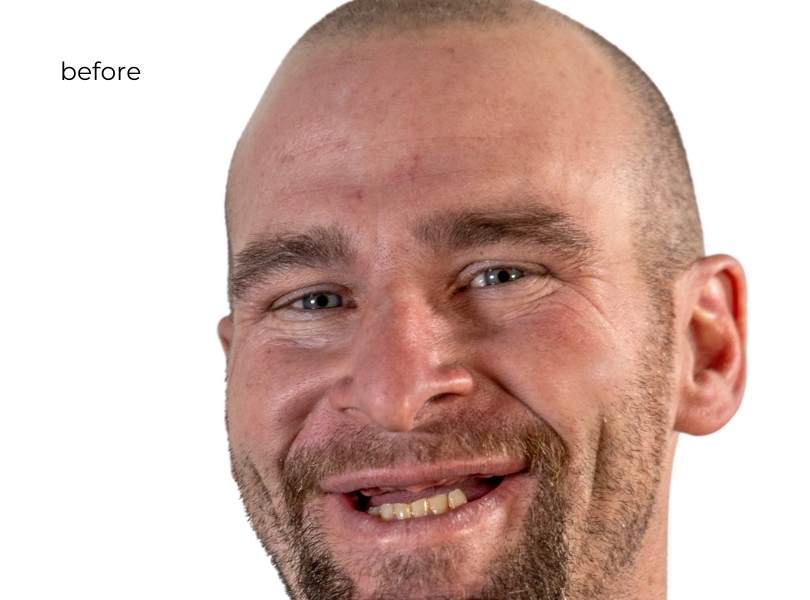 Man smiling before dental implants