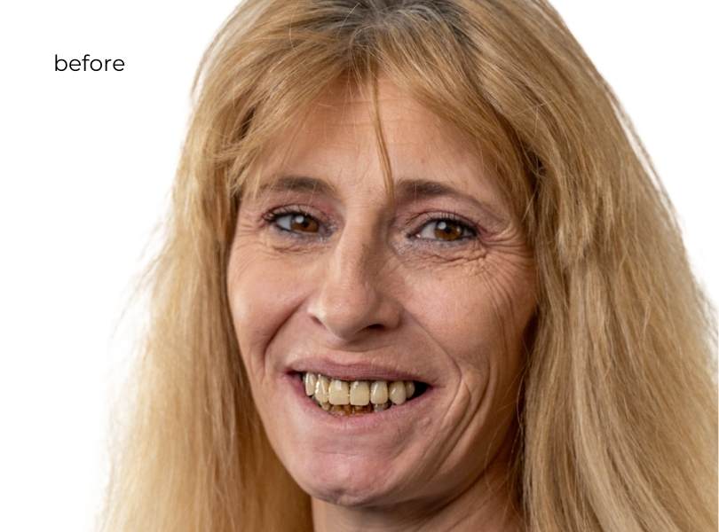 woman smiling before dental implants
