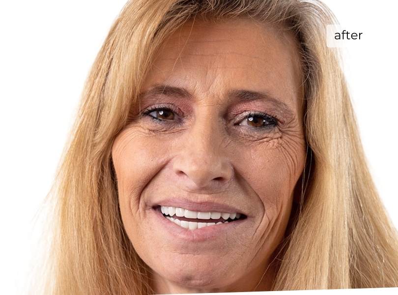 Woman smiling after dental implants