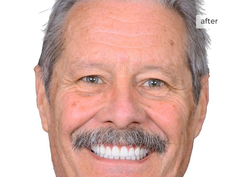 Man smiling after getting dental implants