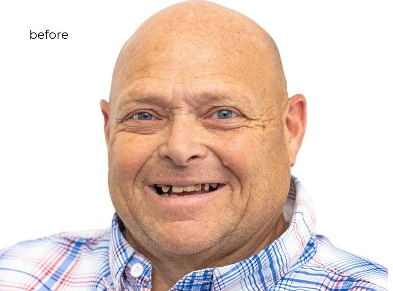 Man smiling before getting dental implants