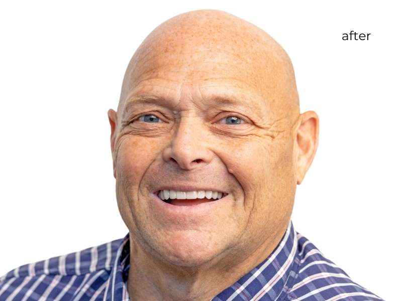 Man smiling after getting dental implants