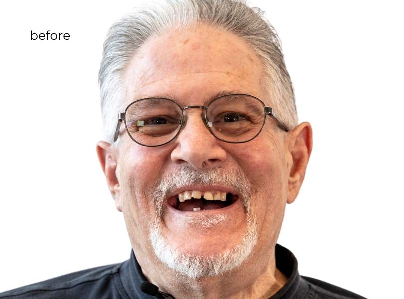 Man smiling before dental implants