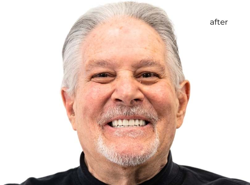 man smiling after getting dental implants