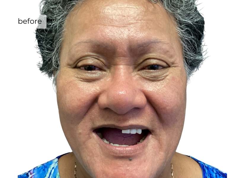 woman smiling before getting dental implants