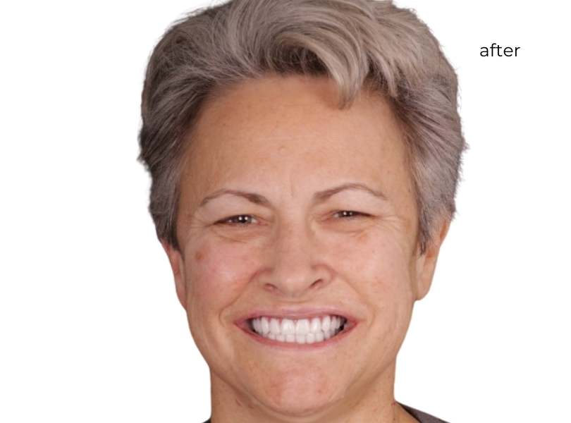 Man smiling after getting dental implants