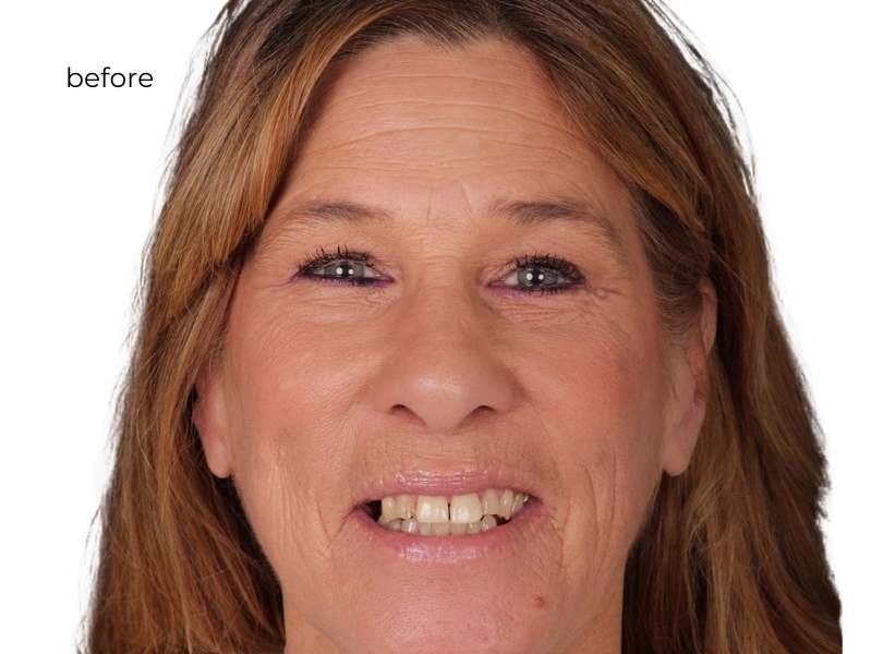 Man smiling before dental implants