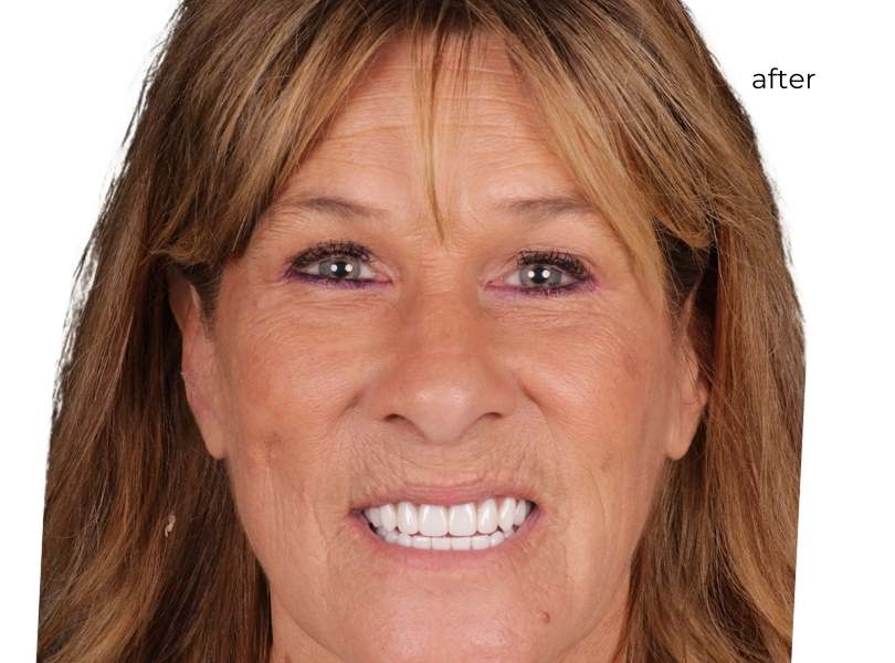 man smiling after getting dental implants