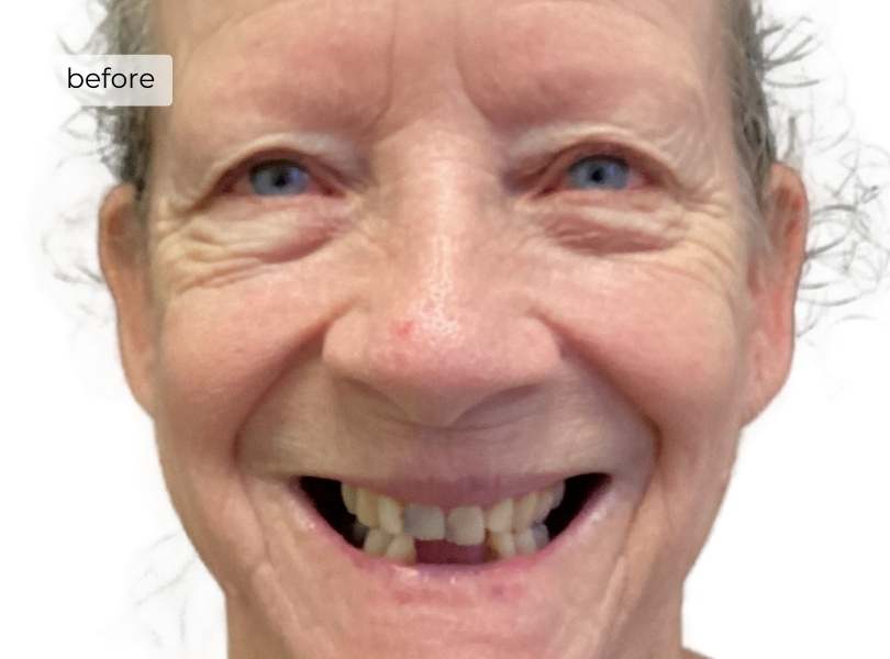 woman smiling before dental implants