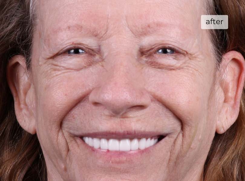 Woman smiling after dental implants